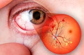 Tratamento para Retina